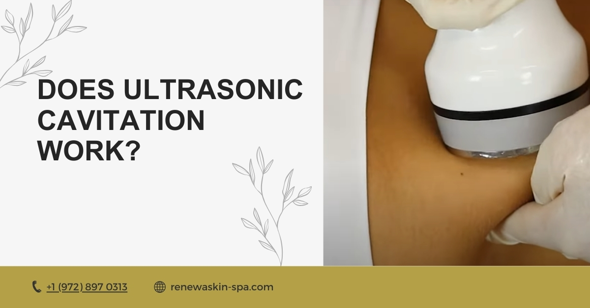 Does Ultrasonic Cavitation Work