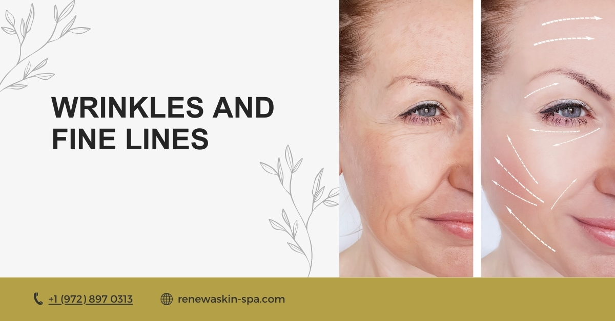 Wrinkles and Fine Lines